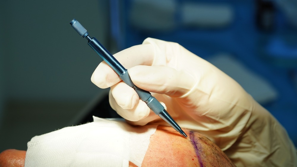 Surgeon using a sapphire blade tool to create precise micro-channels on the scalp during a Sapphire FUE hair transplant In Turkey.