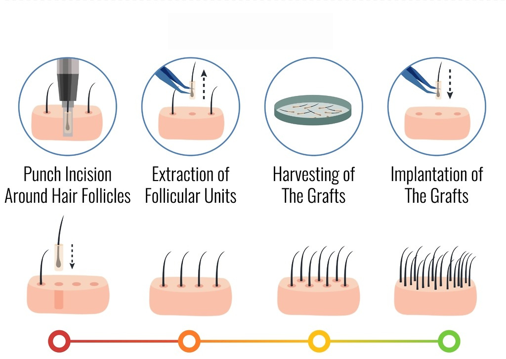 Step-by-step process of Sapphire Hair Transplant in Turkey showing punch incision, follicular unit extraction, graft harvesting, and implantation stages. 