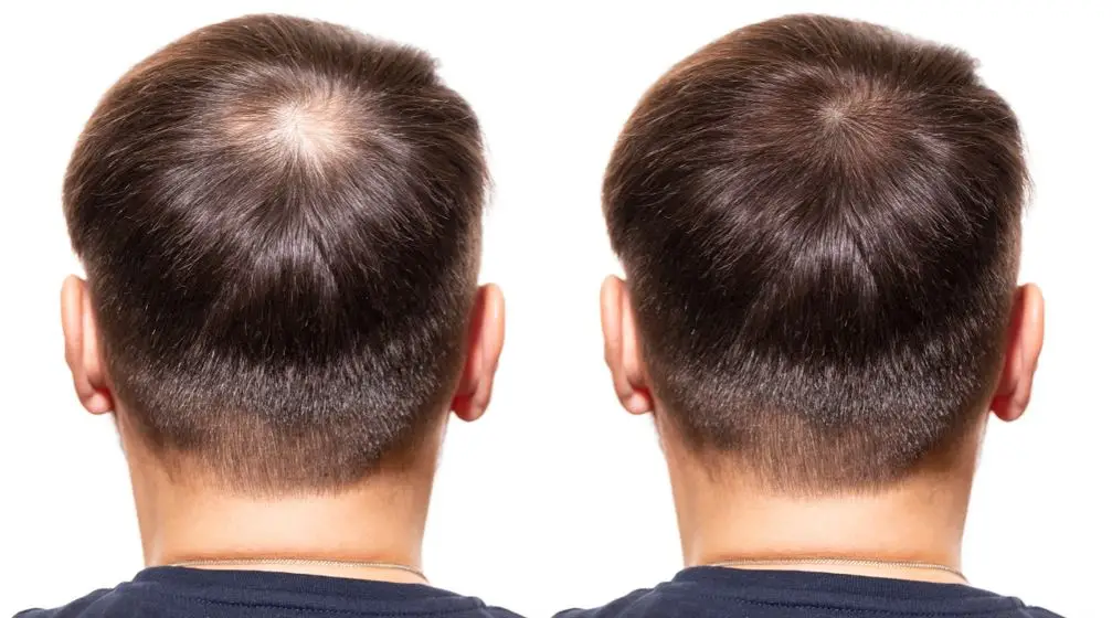  Hestanbul-Hair-loss-prp-hairtransplant