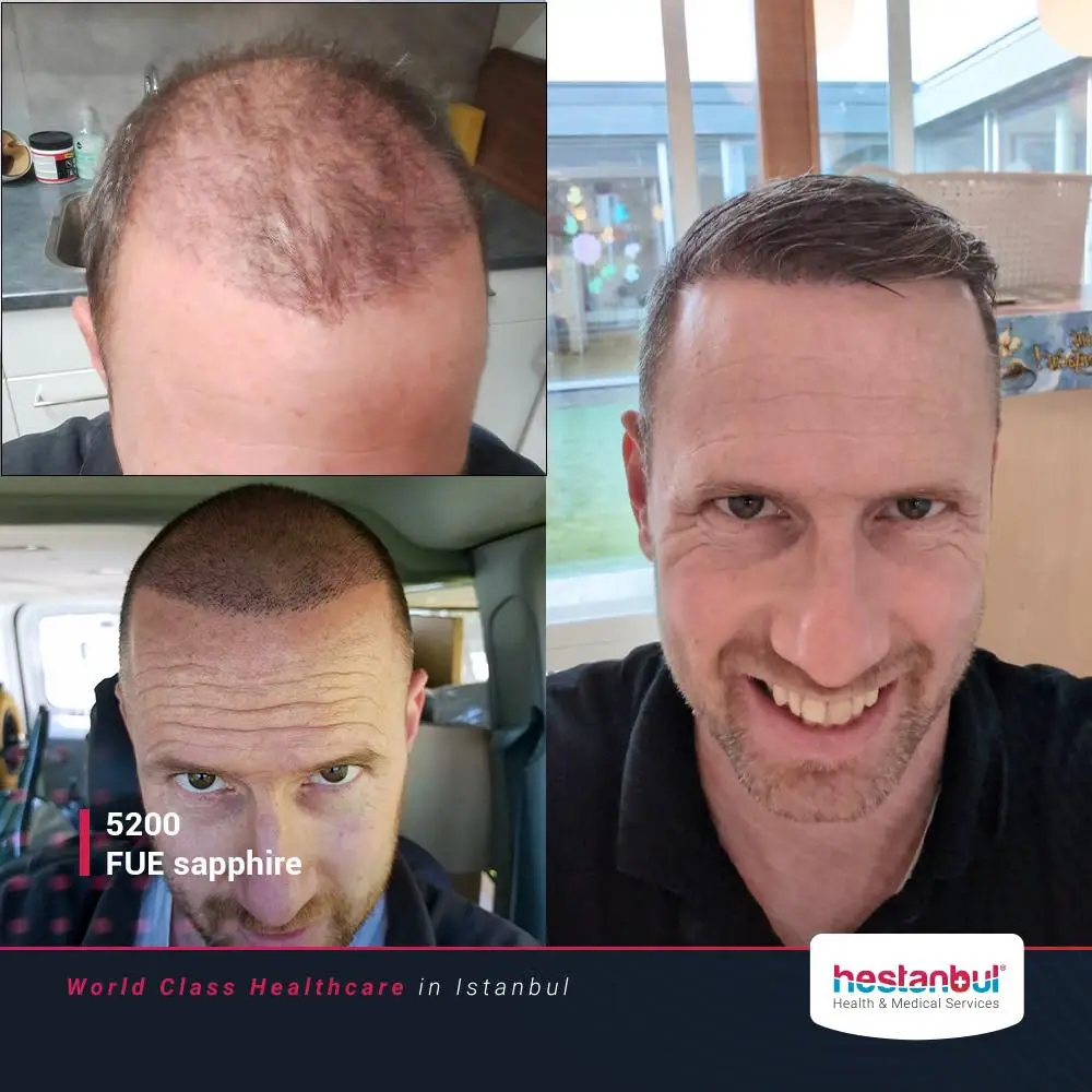 Hair Transplant in Turkey Benefits ;;