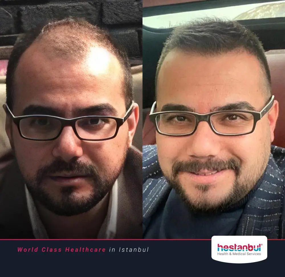 Hair Transplant in Turkey Benefits 1