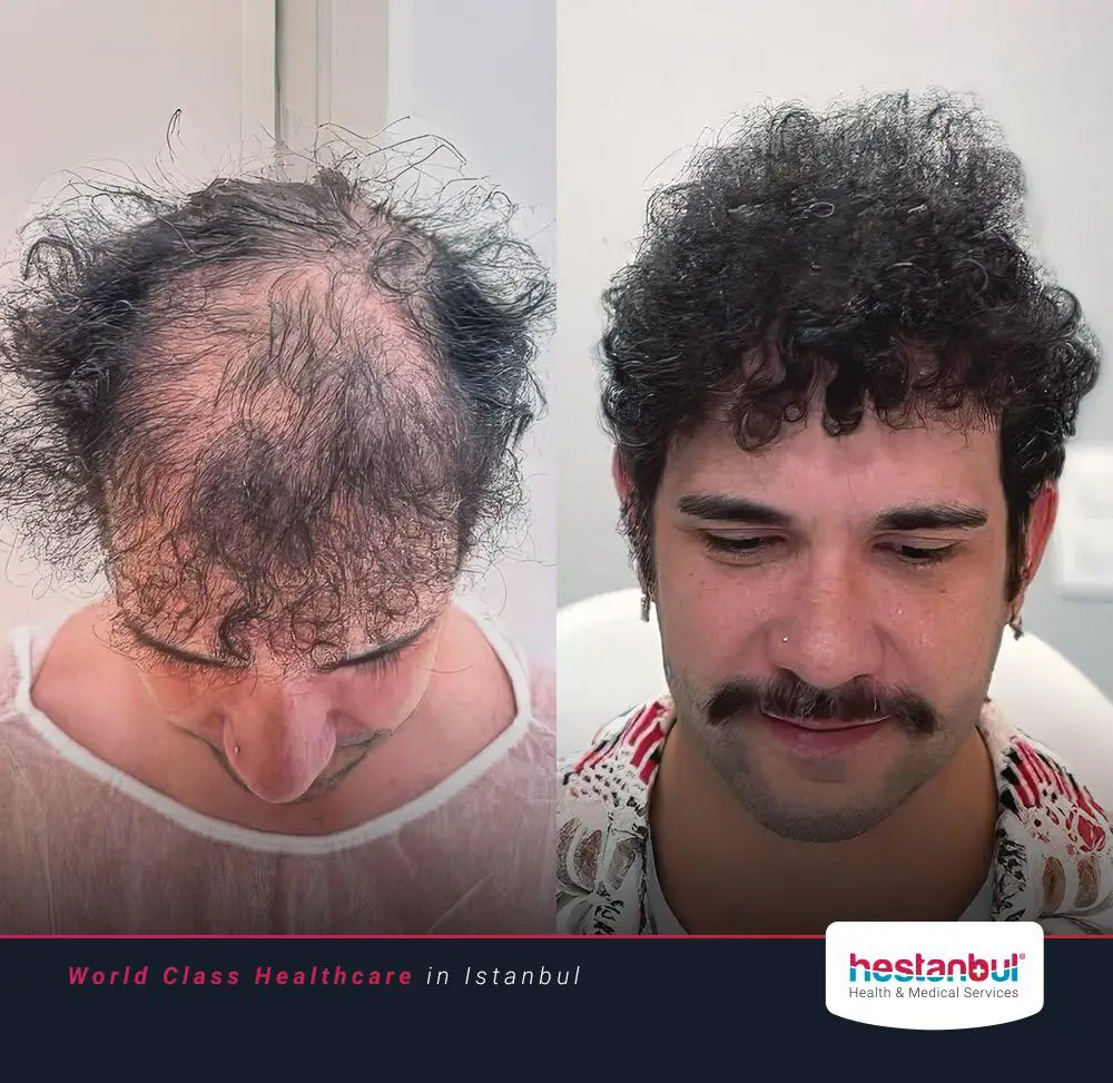 Hair Transplant in Turkey Benefits 2