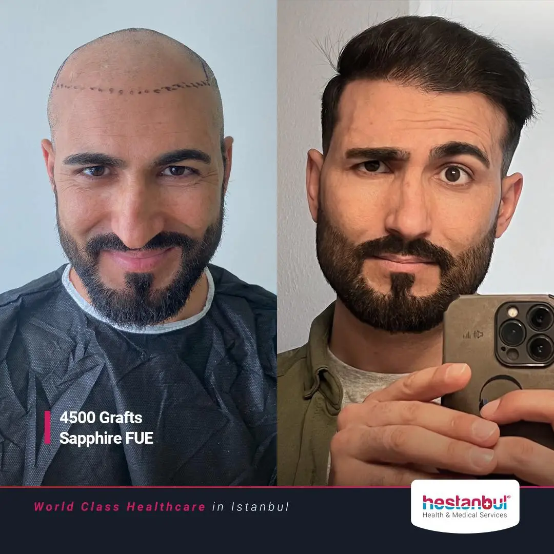 Hair Transplant in Turkey Benefits...