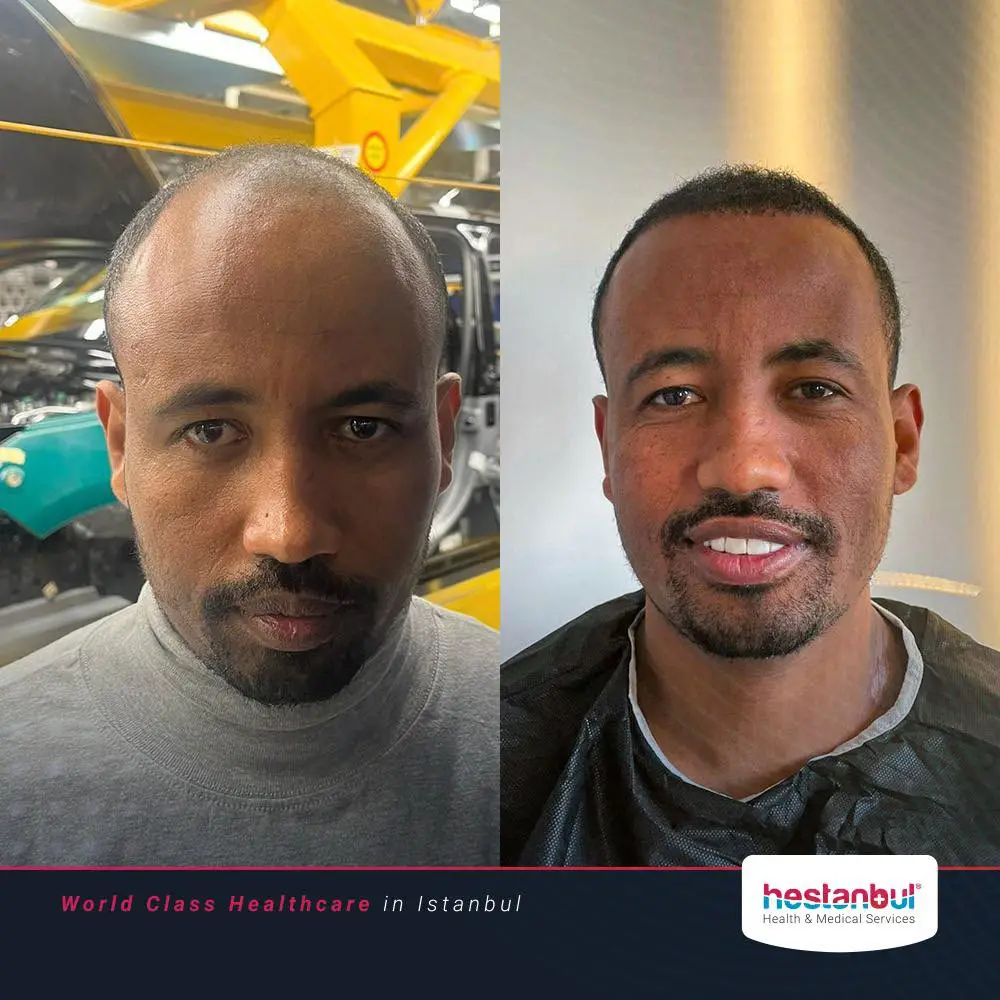 Hair Transplant in Turkey Benefits