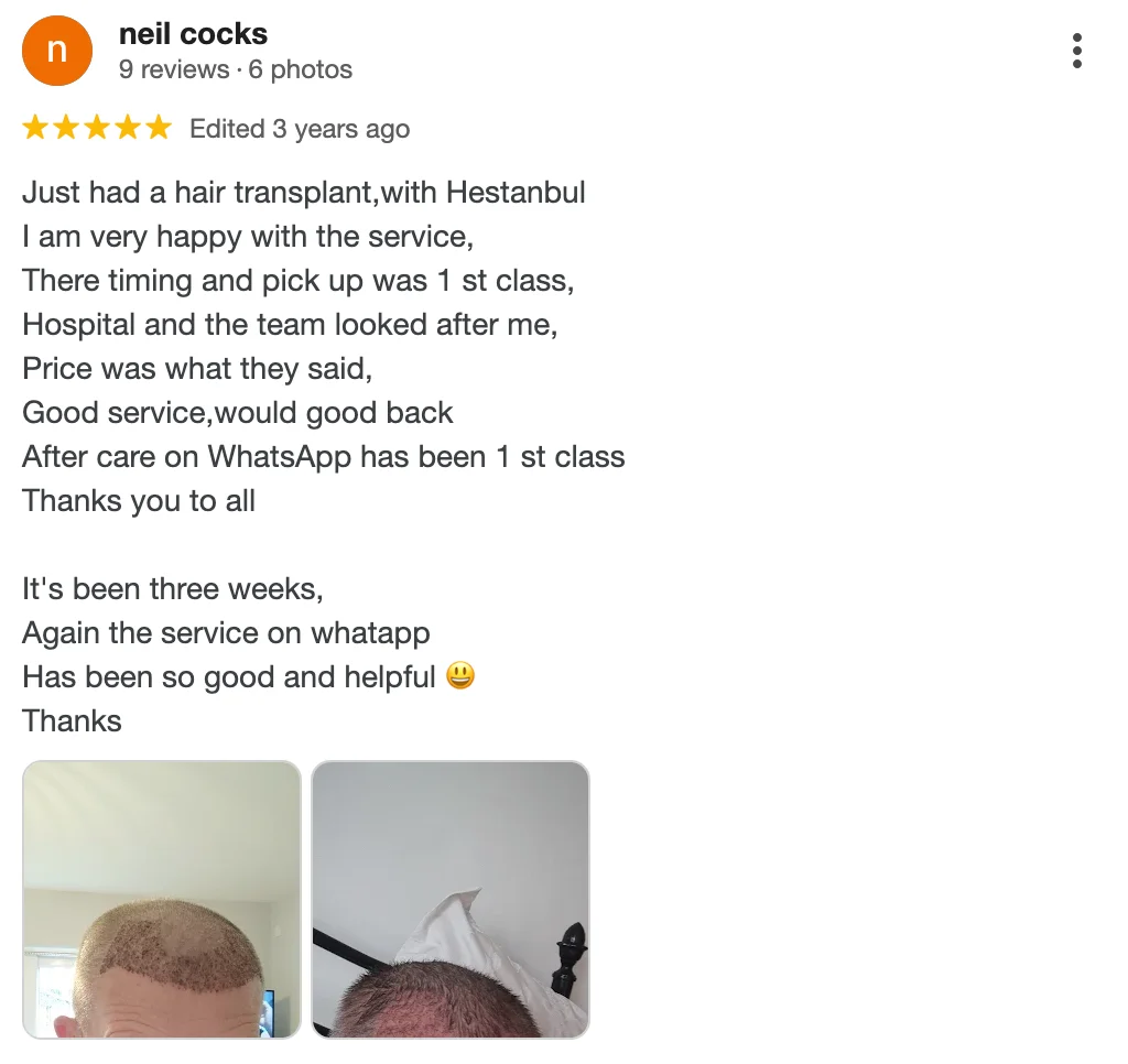 Hestanbul Hair Transplant In Turkey Review 1